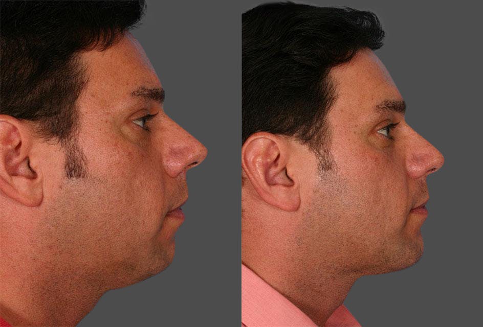 Chin and Cheek Augmentation Before & After Gallery - Patient 420478 - Image 2