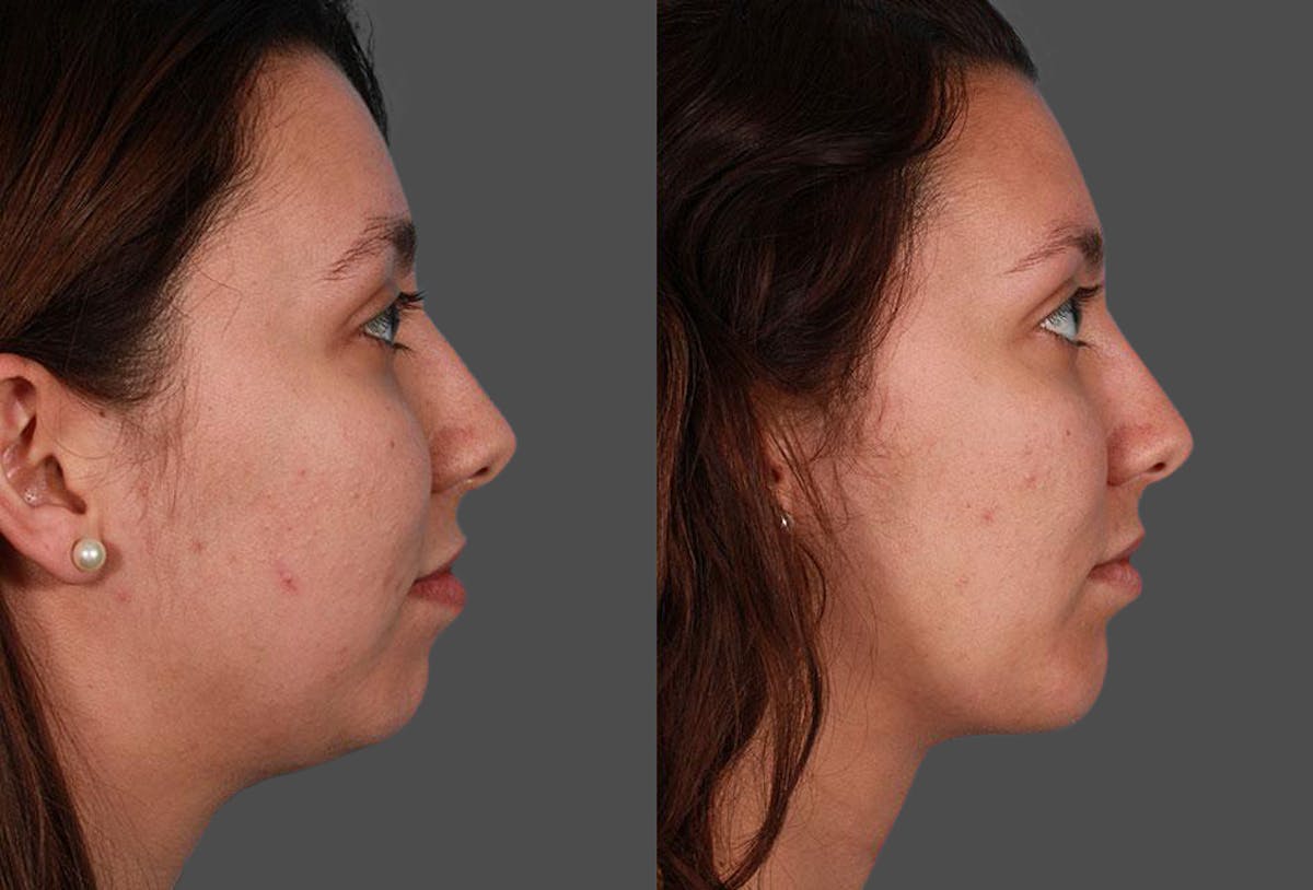Chin and Cheek Augmentation Before & After Gallery - Patient 427901 - Image 1