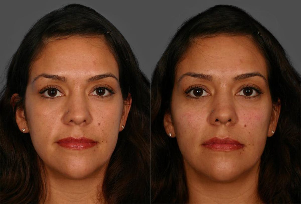 Chin and Cheek Augmentation Before & After Gallery - Patient 687329 - Image 1