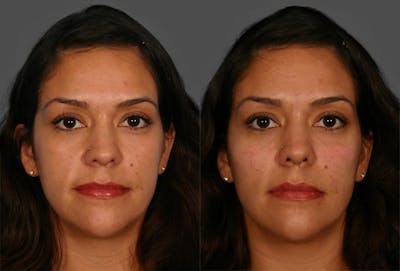 Chin and Cheek Augmentation Before & After Gallery - Patient 687329 - Image 1