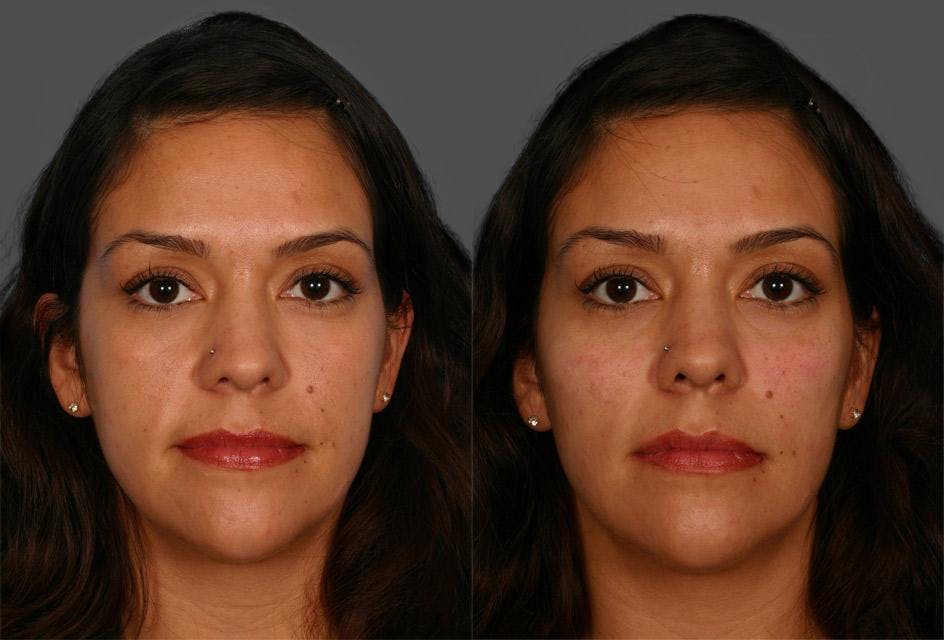 Chin and Cheek Augmentation Before & After Gallery - Patient 687329 - Image 1