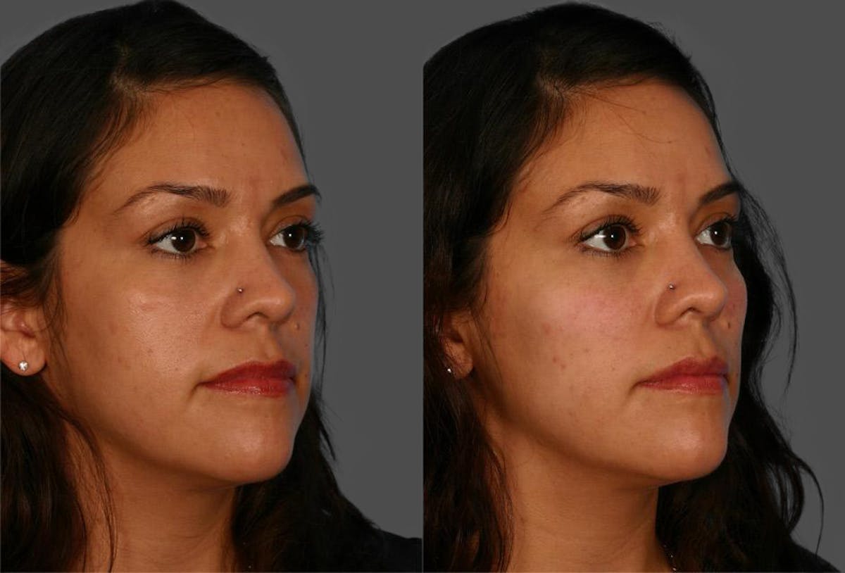 Chin and Cheek Augmentation Before & After Gallery - Patient 687329 - Image 2