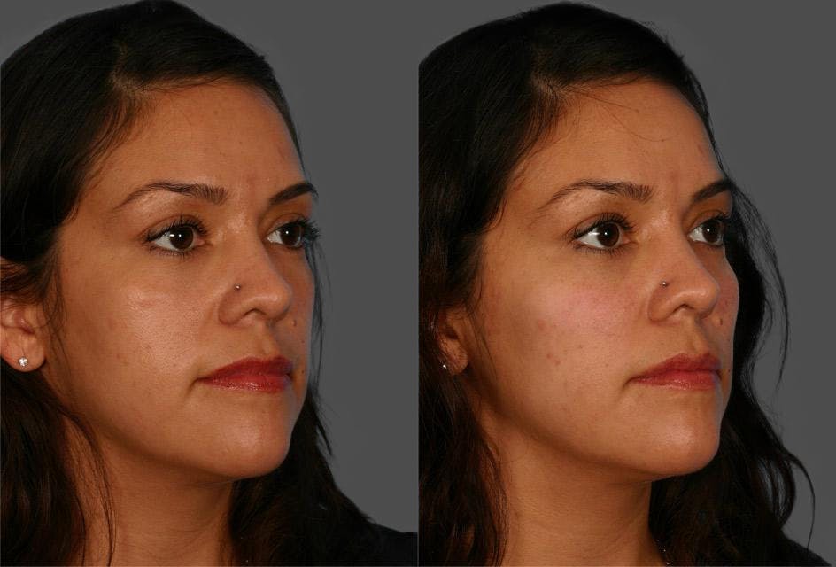 Chin and Cheek Augmentation Before & After Gallery - Patient 687329 - Image 2