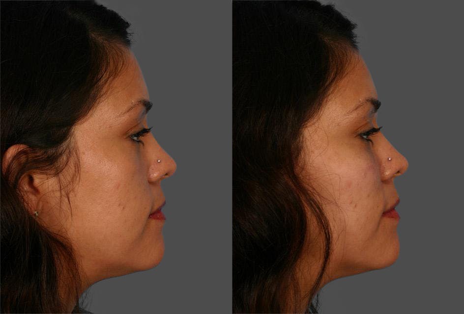 Chin and Cheek Augmentation Before & After Gallery - Patient 687329 - Image 3