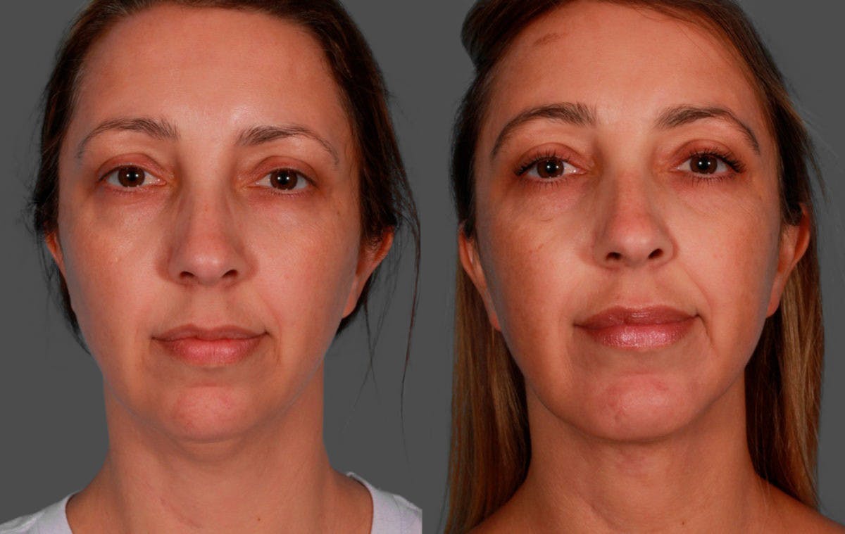 Chin and Cheek Augmentation Before & After Gallery - Patient 704319 - Image 1