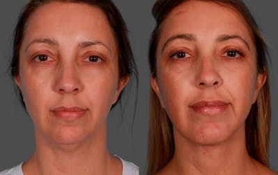 Chin and Cheek Augmentation Before & After Gallery - Patient 704319 - Image 1
