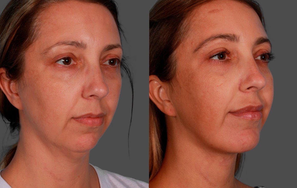 Chin and Cheek Augmentation Before & After Gallery - Patient 704319 - Image 2