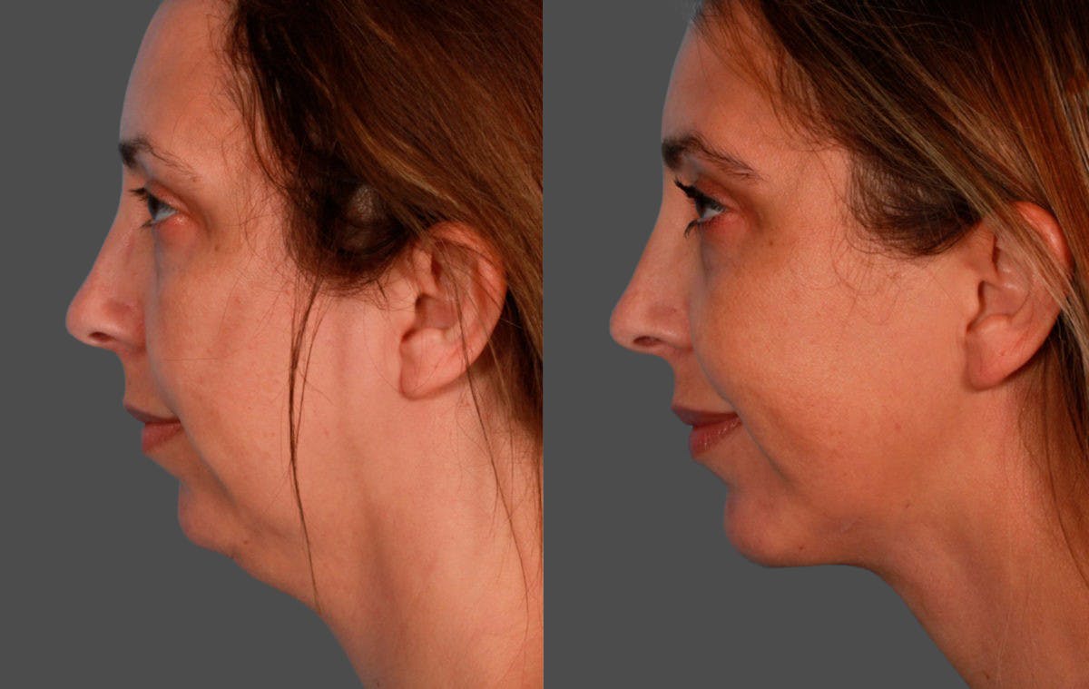 Chin and Cheek Augmentation Before & After Gallery - Patient 704319 - Image 3