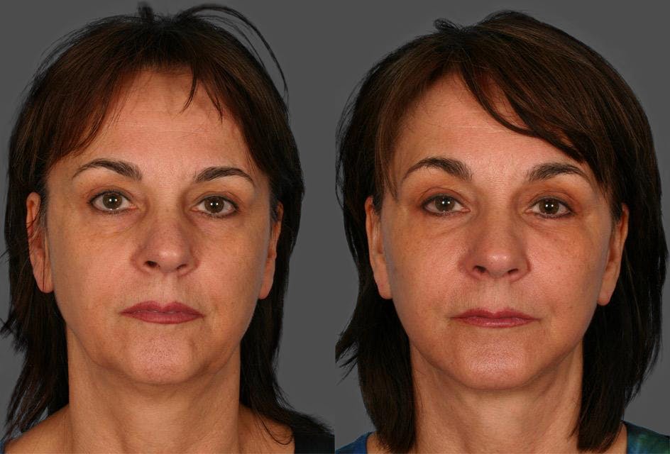 Chin and Cheek Augmentation Before & After Gallery - Patient 770639 - Image 1