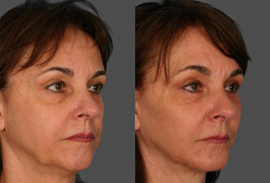 Chin and Cheek Augmentation Before & After Gallery - Patient 770639 - Image 2