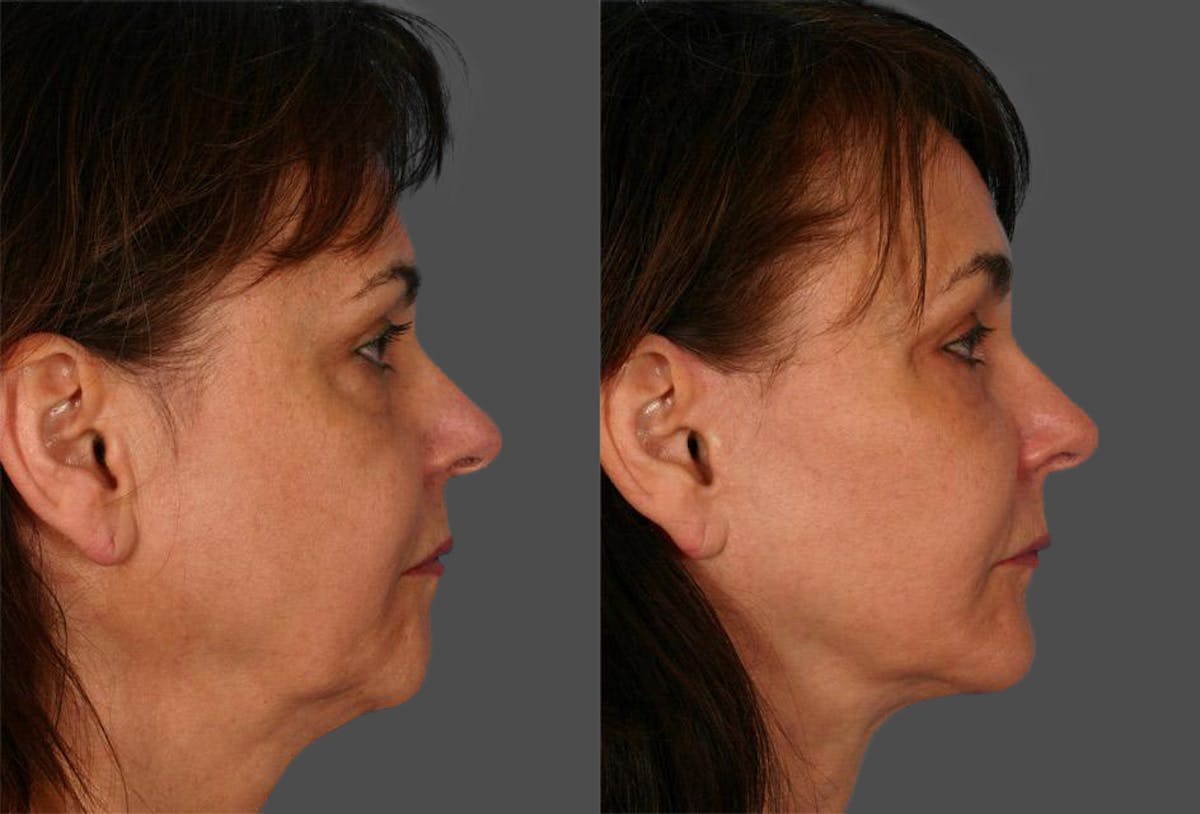 Chin and Cheek Augmentation Before & After Gallery - Patient 770639 - Image 3