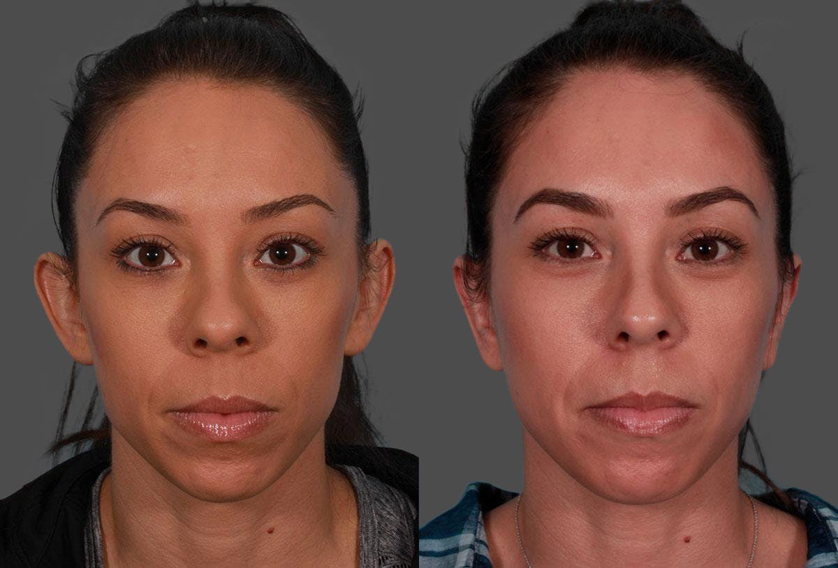 Ear Surgery (Otoplasty) Before & After Gallery - Patient 125281 - Image 1