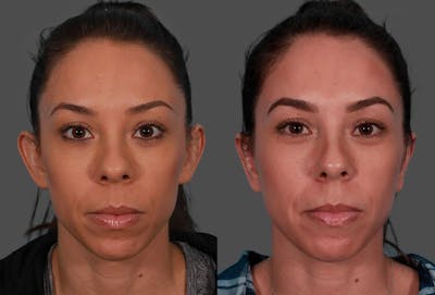 Ear Surgery (Otoplasty) Before & After Gallery - Patient 125281 - Image 1