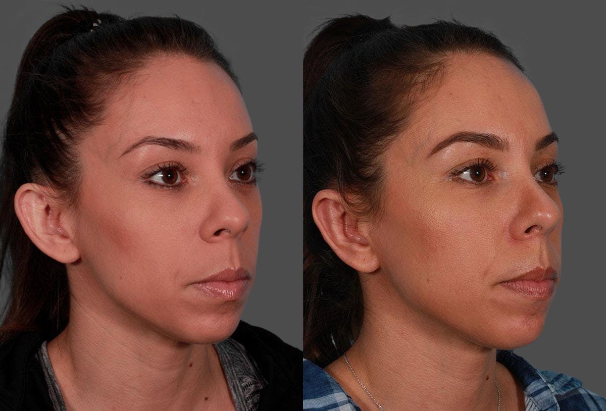 Ear Surgery (Otoplasty) Before & After Gallery - Patient 125281 - Image 2