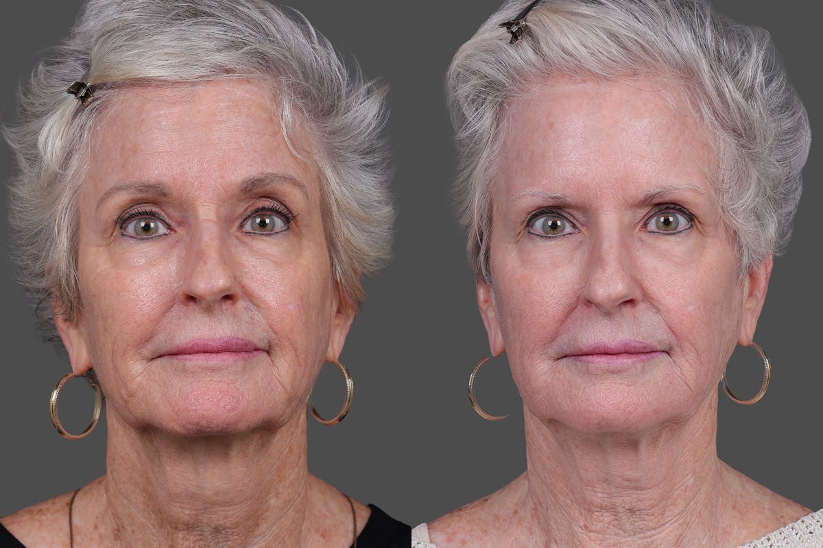 BBL (BroadBand Light)  Before & After Gallery - Patient 197135 - Image 1