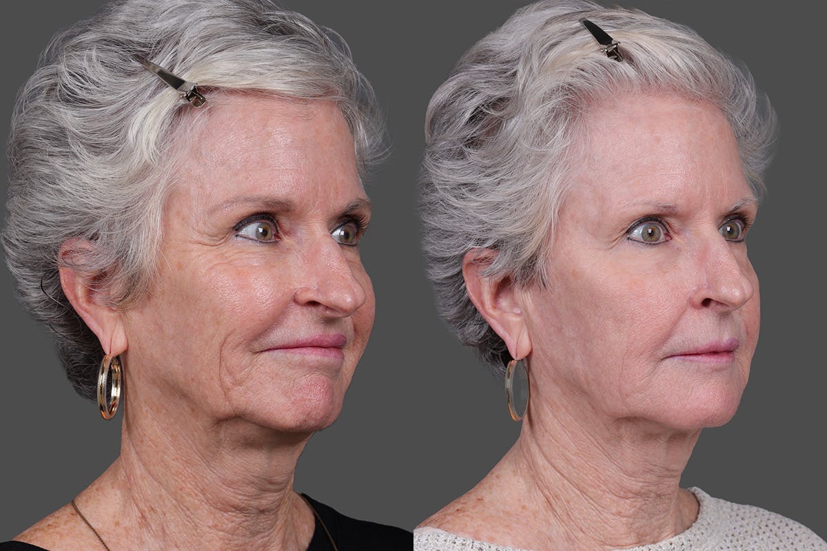 BBL (BroadBand Light)  Before & After Gallery - Patient 197135 - Image 2