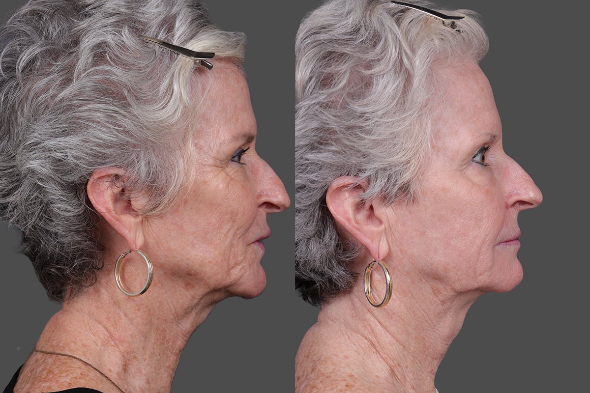 BBL (BroadBand Light)  Before & After Gallery - Patient 197135 - Image 3