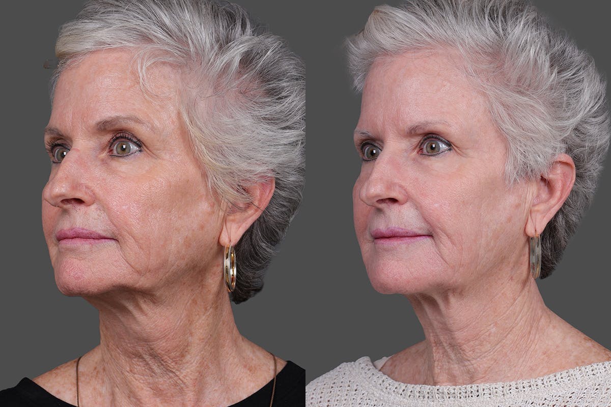 BBL (BroadBand Light)  Before & After Gallery - Patient 197135 - Image 4