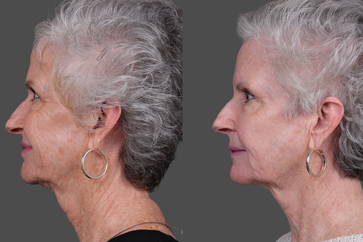 BBL (BroadBand Light)  Before & After Gallery - Patient 197135 - Image 5