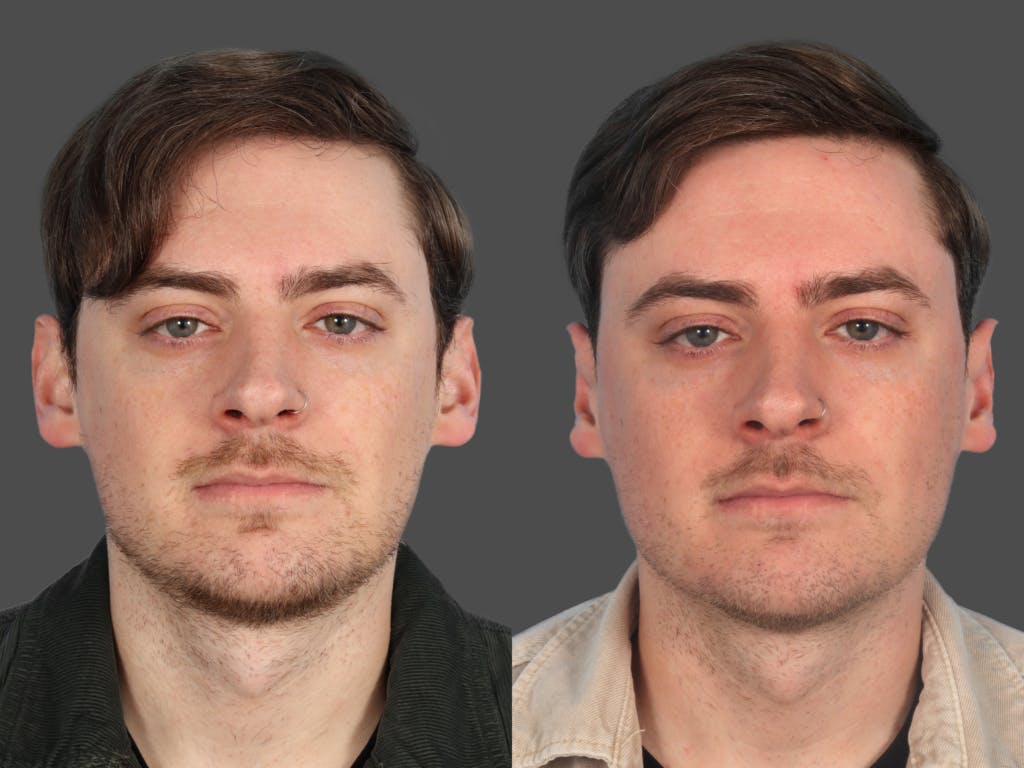 Ear Surgery (Otoplasty) Before & After Gallery - Patient 126372 - Image 1