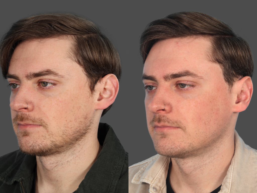 Ear Surgery (Otoplasty) Before & After Gallery - Patient 126372 - Image 2