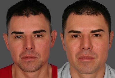 Ear Surgery (Otoplasty) Before & After Gallery - Patient 150626 - Image 1