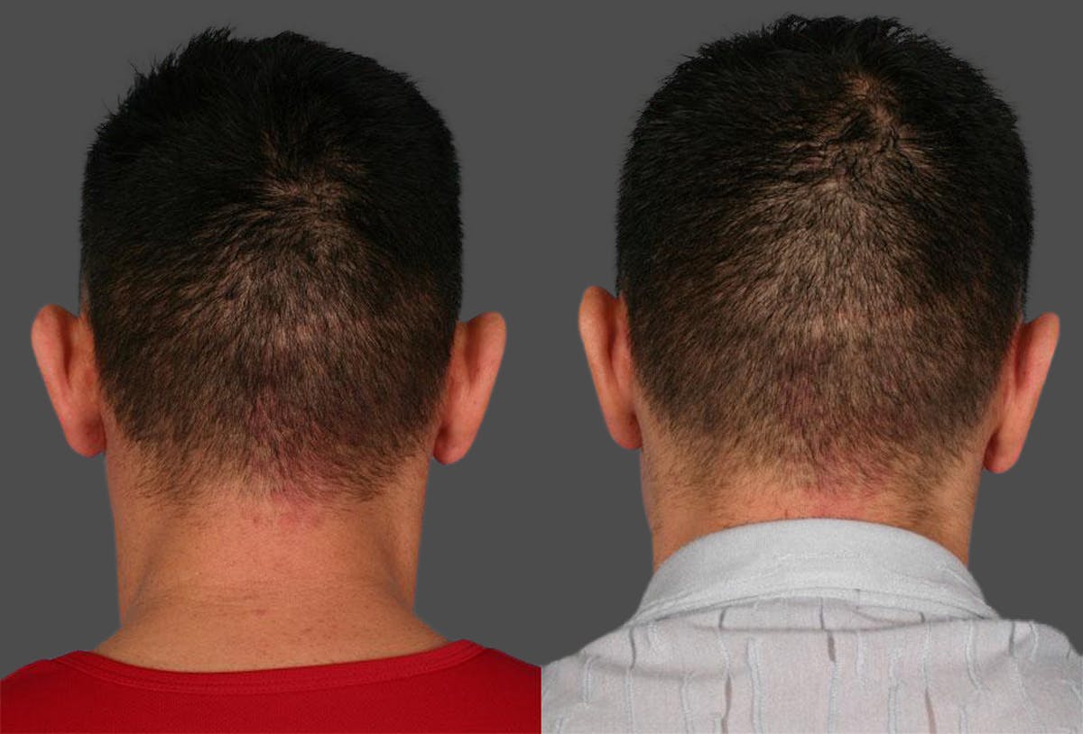 Ear Surgery (Otoplasty) Before & After Gallery - Patient 150626 - Image 2