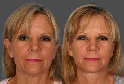 Ear Surgery (Otoplasty) Before & After Gallery - Patient 175043 - Image 1