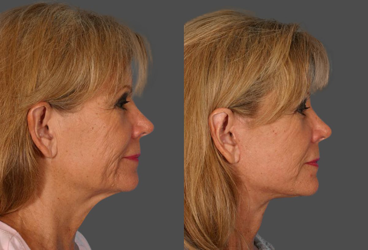 Ear Surgery (Otoplasty) Before & After Gallery - Patient 175043 - Image 2