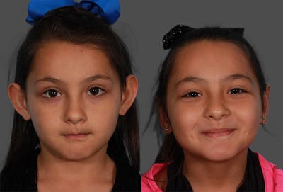 Ear Surgery (Otoplasty) Before & After Gallery - Patient 224665 - Image 1