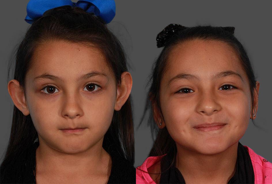 Ear Surgery (Otoplasty) Before & After Gallery - Patient 224665 - Image 1