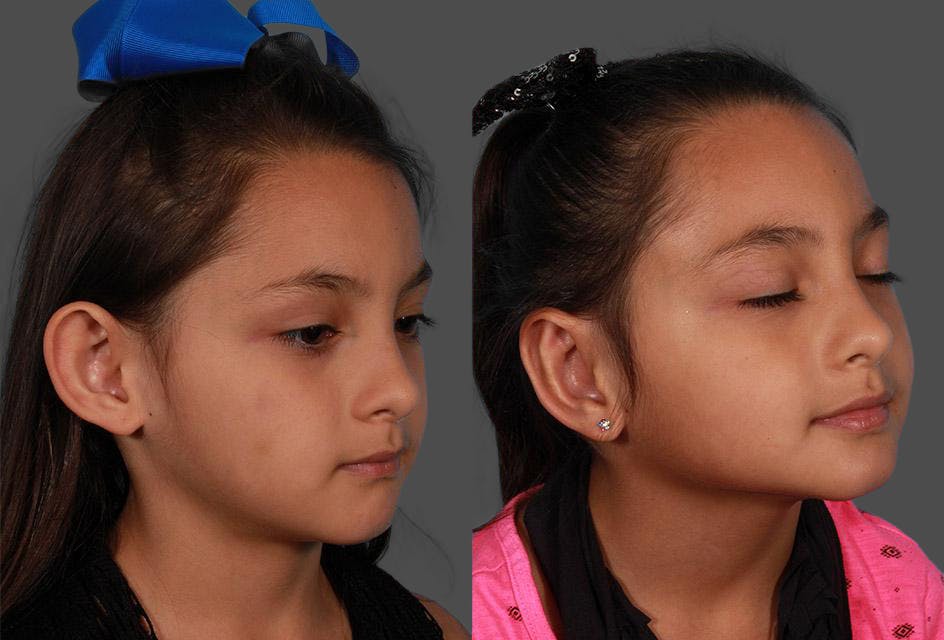 Ear Surgery (Otoplasty) Before & After Gallery - Patient 224665 - Image 2