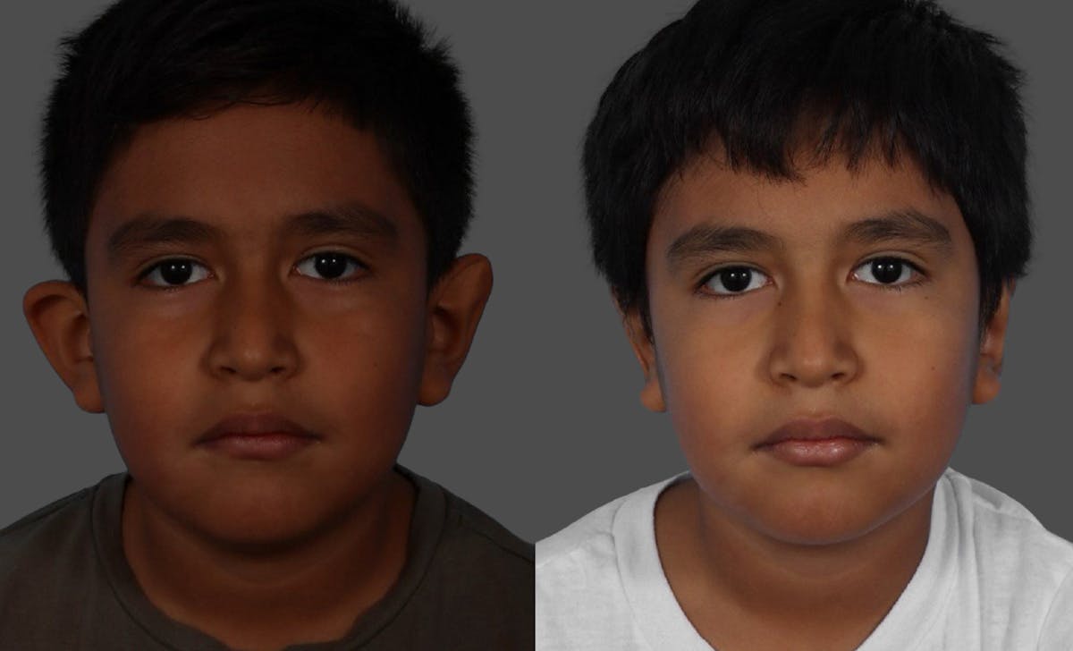 Ear Surgery (Otoplasty) Before & After Gallery - Patient 227666 - Image 1