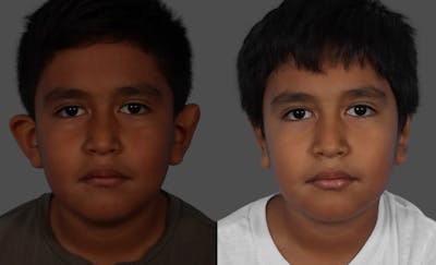 Ear Surgery (Otoplasty) Before & After Gallery - Patient 227666 - Image 1