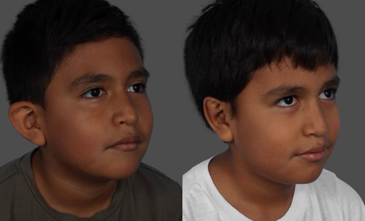Ear Surgery (Otoplasty) Before & After Gallery - Patient 227666 - Image 2
