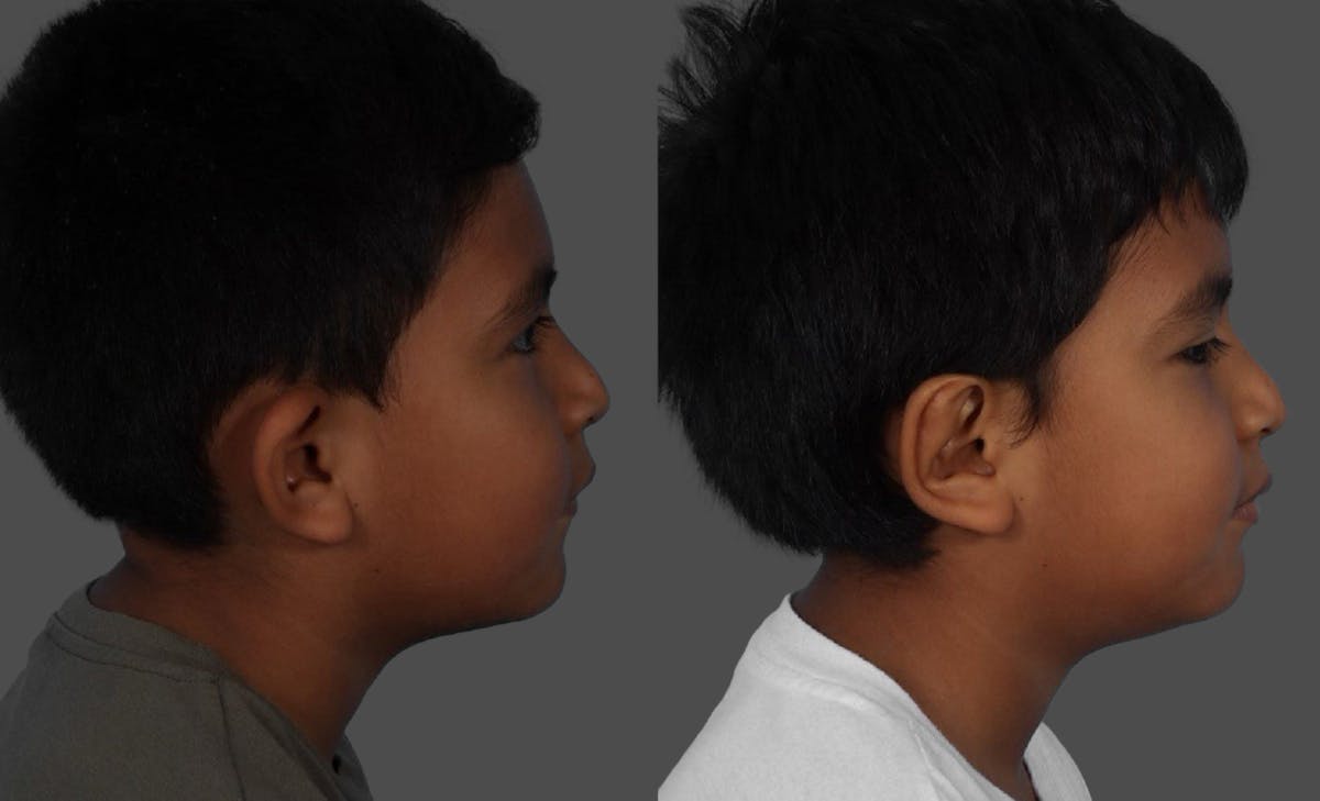 Ear Surgery (Otoplasty) Before & After Gallery - Patient 227666 - Image 3