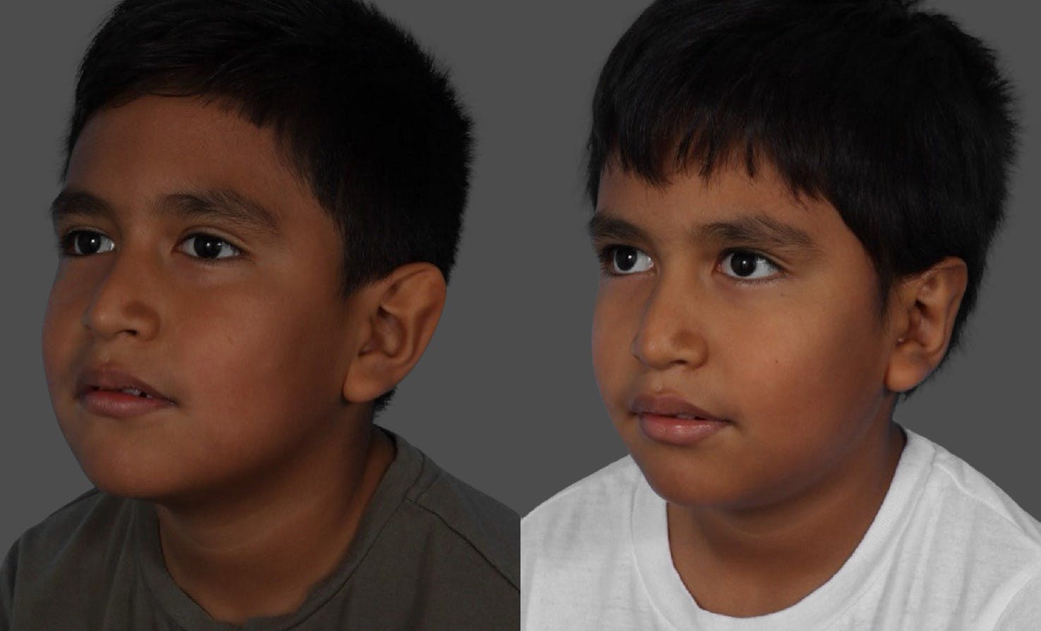 Ear Surgery (Otoplasty) Before & After Gallery - Patient 227666 - Image 4