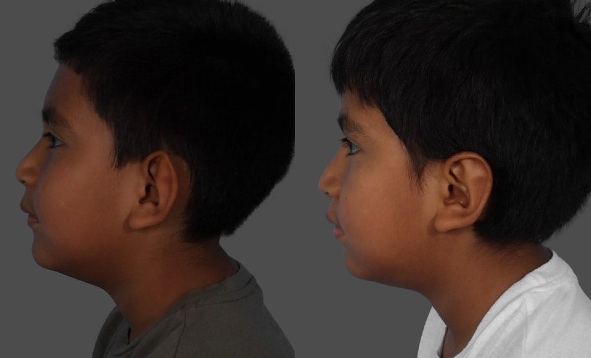 Ear Surgery (Otoplasty) Before & After Gallery - Patient 227666 - Image 5
