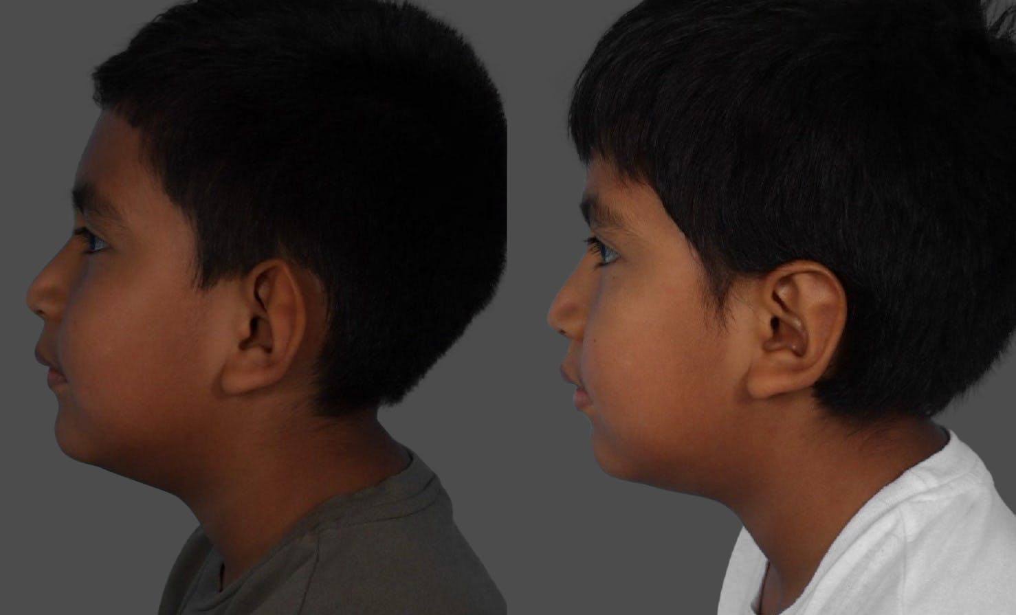 Ear Surgery (Otoplasty) Before & After Gallery - Patient 227666 - Image 5
