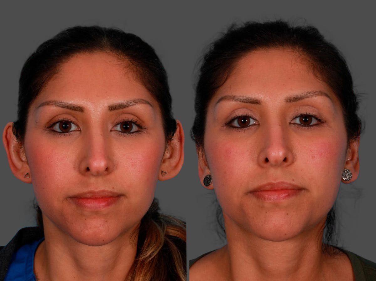 Ear Surgery (Otoplasty) Before & After Gallery - Patient 232046 - Image 1