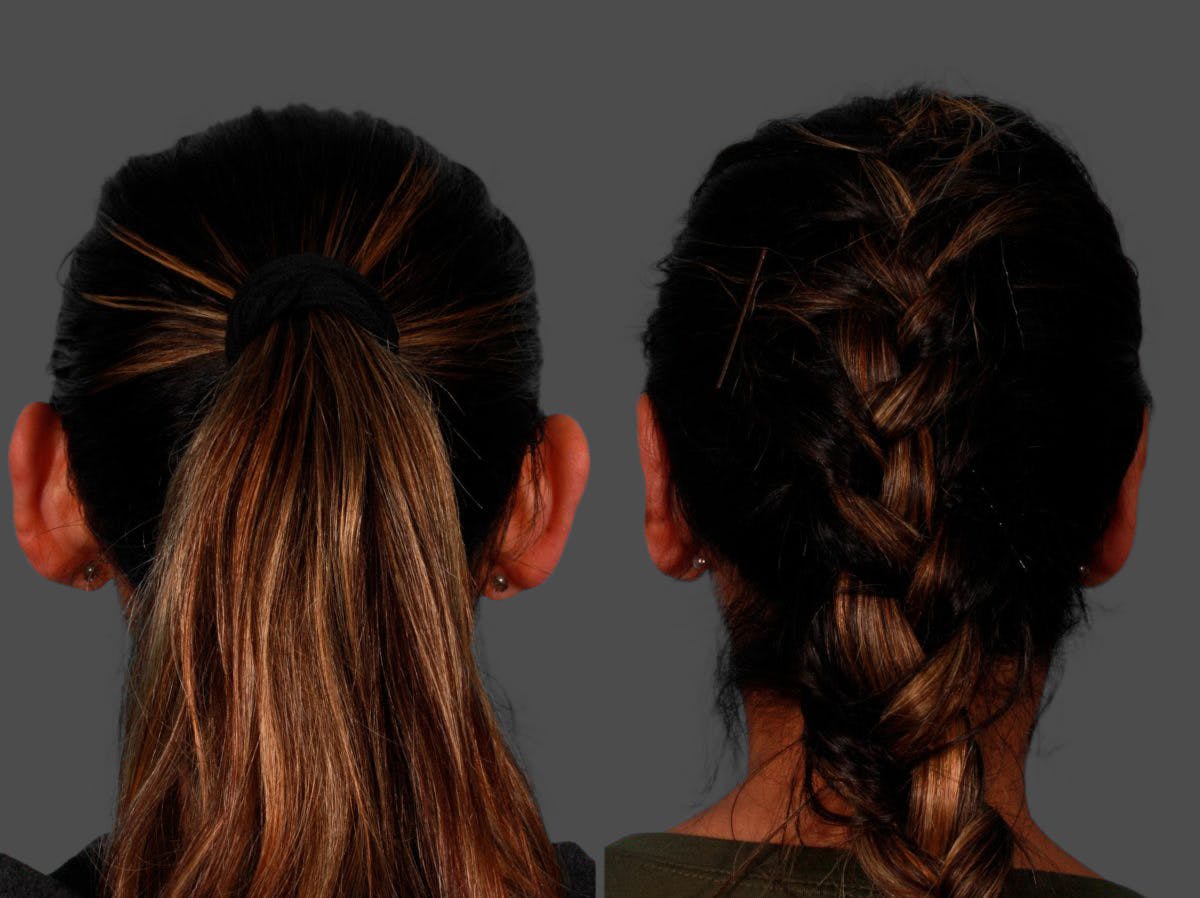 Ear Surgery (Otoplasty) Before & After Gallery - Patient 232046 - Image 2