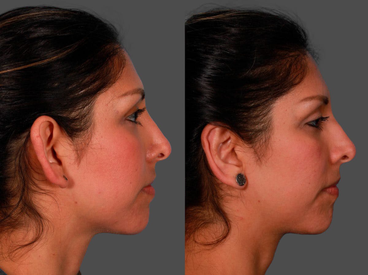 Ear Surgery (Otoplasty) Before & After Gallery - Patient 232046 - Image 3