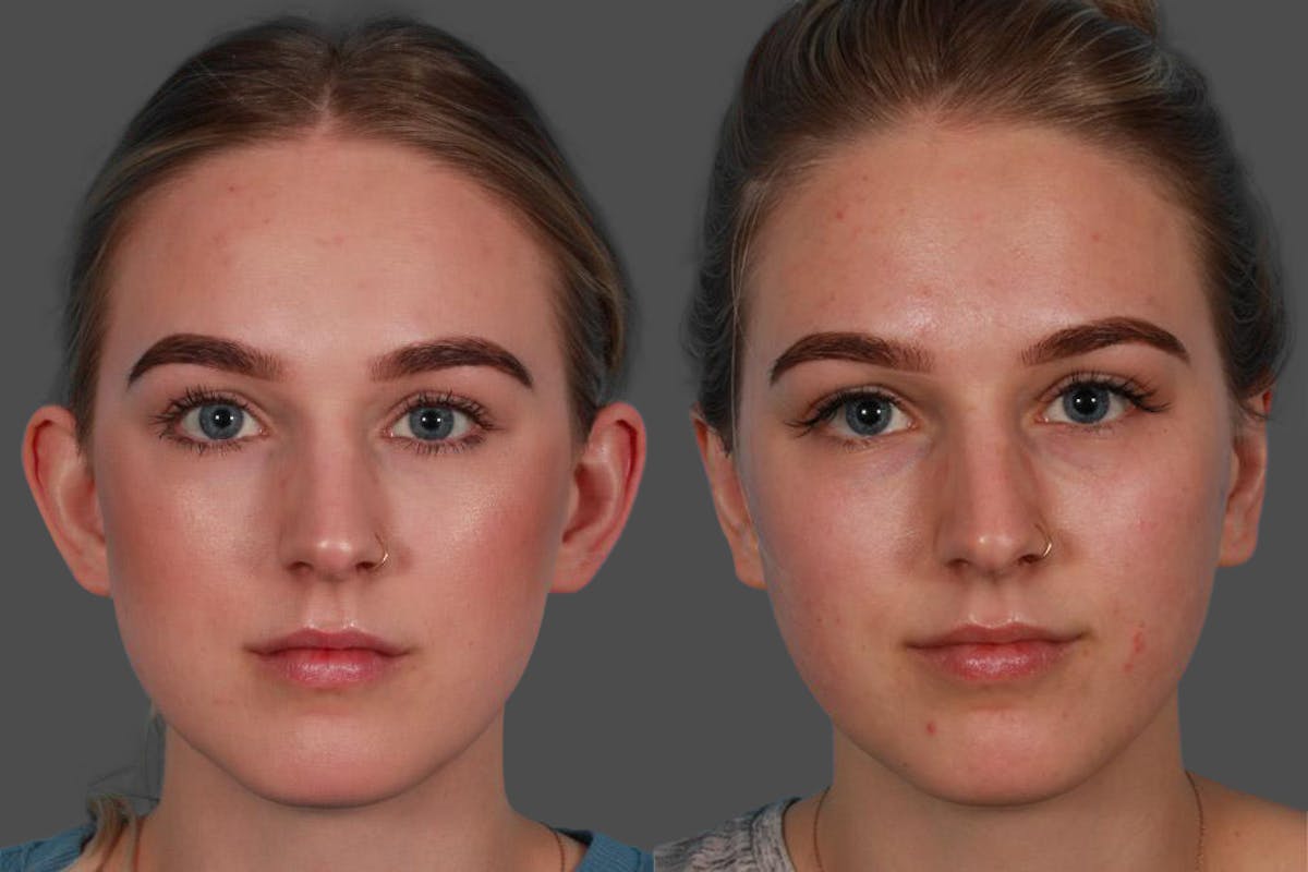Ear Surgery (Otoplasty) Before & After Gallery - Patient 240366 - Image 1
