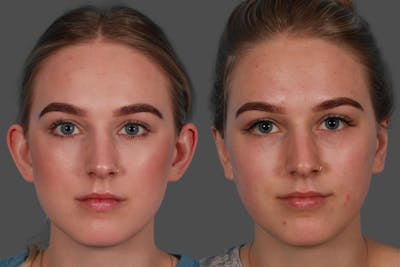 Ear Surgery (Otoplasty) Before & After Gallery - Patient 240366 - Image 1