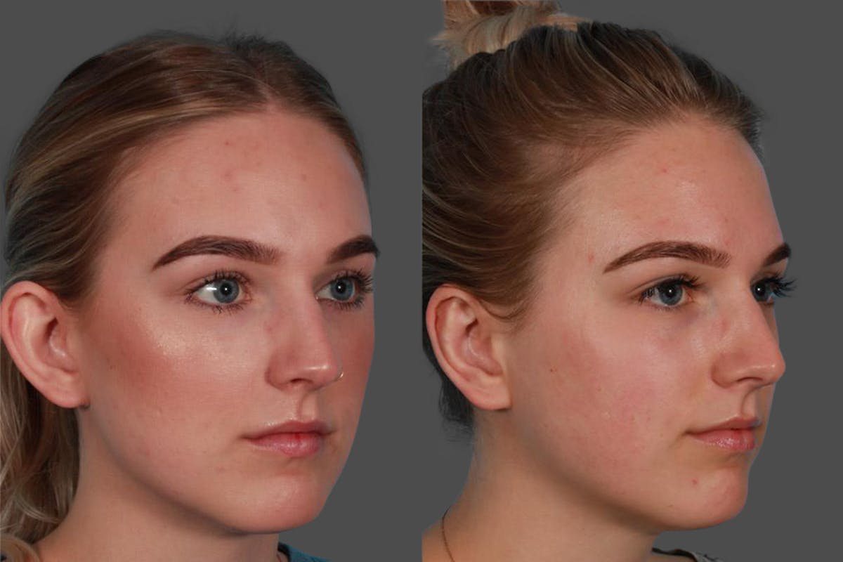 Ear Surgery (Otoplasty) Before & After Gallery - Patient 240366 - Image 2