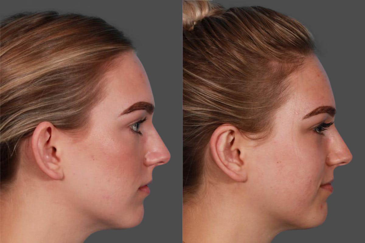 Ear Surgery (Otoplasty) Before & After Gallery - Patient 240366 - Image 3