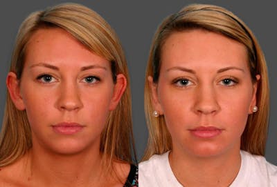Ear Surgery (Otoplasty) Before & After Gallery - Patient 251414 - Image 1