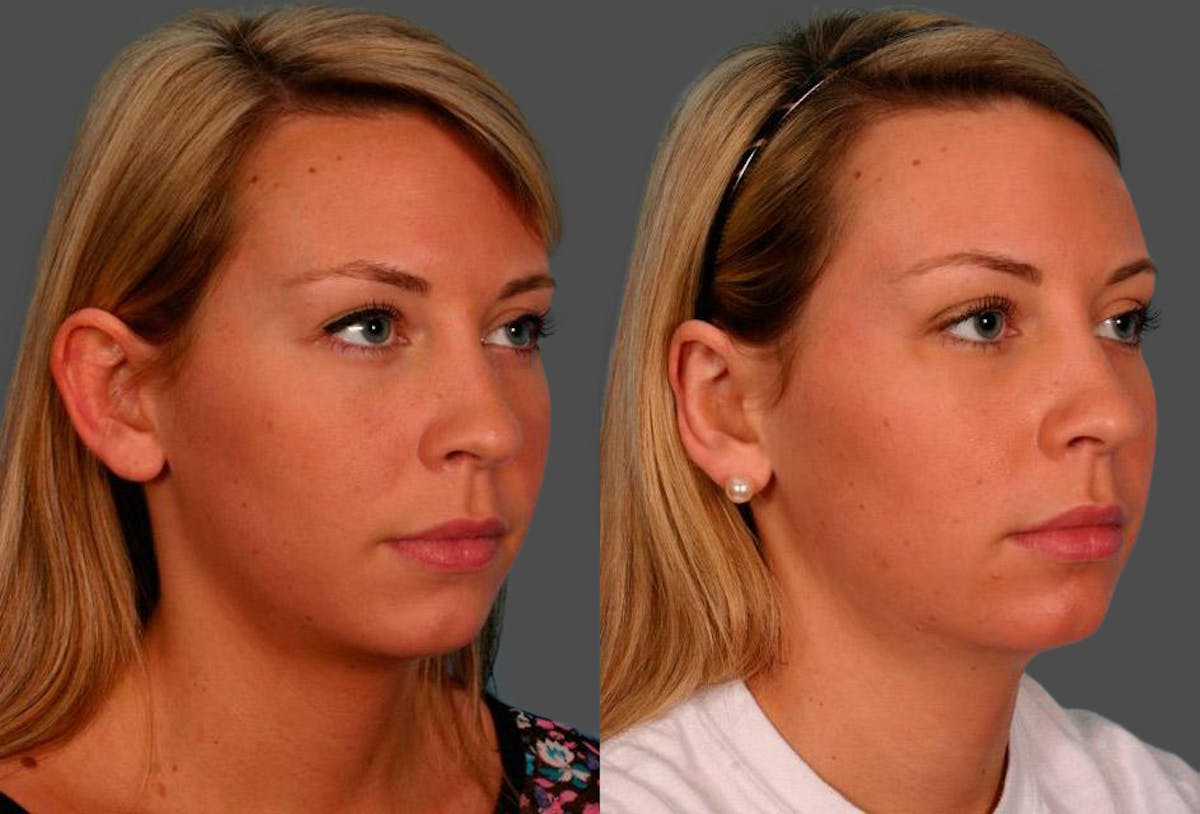 Ear Surgery (Otoplasty) Before & After Gallery - Patient 251414 - Image 2
