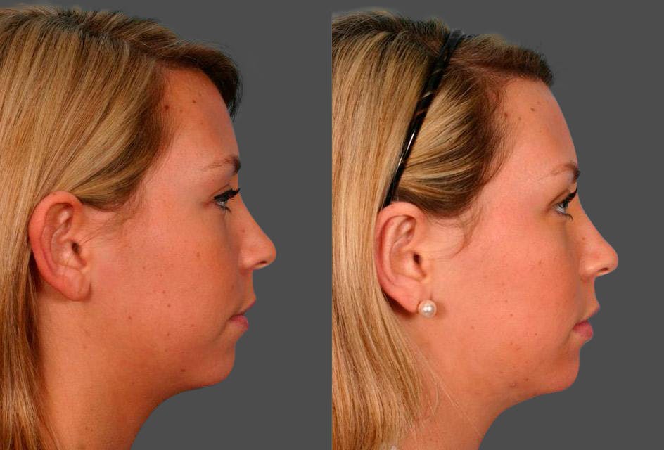 Ear Surgery (Otoplasty) Before & After Gallery - Patient 251414 - Image 3