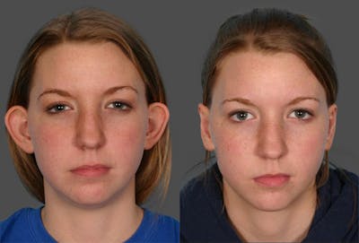 Ear Surgery (Otoplasty) Before & After Gallery - Patient 260357 - Image 1